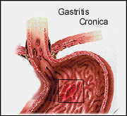 GASTRITIS DEFINICION gastritis definicion: