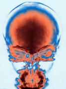 Sobrecarga cerebral