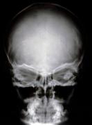 Infarto y daño al cerebro