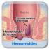 Remedios para hemorroides Remedios para hemorroides