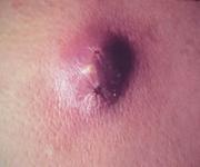 Abscess