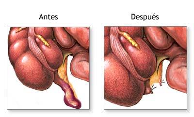 Apendicectomía