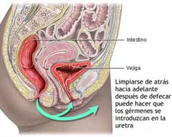 Cistitis e higiene apropiada Cistitis e higiene apropiada