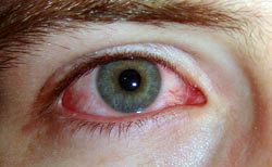 Tratamientos naturales para la conjuntivitis