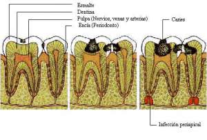 Medicina natural para las caries y encías sangrantes