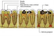 Medicina natural para las caries y encías sangrantes