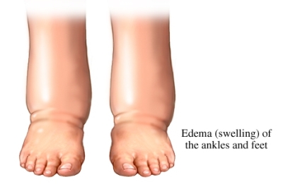 Causas y tipos de edemas Causas y tipos de edemas
