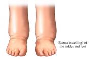 Causas y tipos de edemas