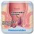 Síntomas y Causas de hemorroides