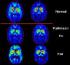 Parkinson y olfato Parkinson y olfato