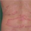 Remedios caseros para la psoriasis Remedios caseros para la psoriasis