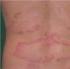Remedios caseros para la psoriasis