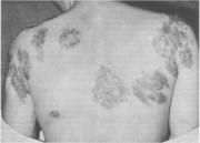 Remedios homeopáticos para la Sífilis