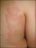 Remedios de Medicina Natural para la Urticaria