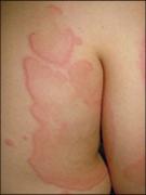 Remedios de Medicina Natural para la Urticaria