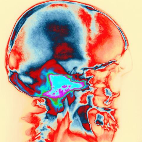 Consejos para la epilepsia
