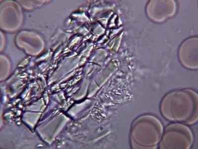 Cristales de ácidos en el plasma sanguíneo