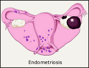 Información sobre endometriosis