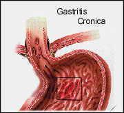 Síntomas de la gastritis