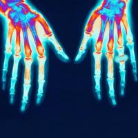 Síntomas de neuropatía periférica Síntomas de neuropatía periférica