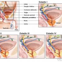 Medicina natural para el adenoma de próstata
