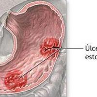 Síntomas y causas de úlceras