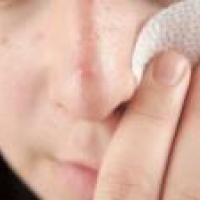 Tipo y síntomas del acné