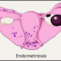 Información sobre endometriosis