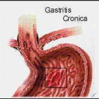 Síntomas de la gastritis