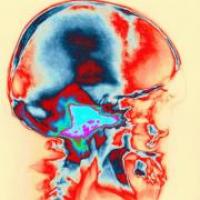 Síntomas y tipos de neuralgias Síntomas y tipos de neuralgias