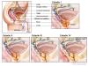 Medicina natural para el adenoma de próstata