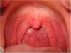 Medicina natural para la garganta irritada