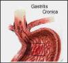 Diferentes causas de la gastritis