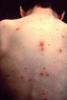 Síntomas de varicela