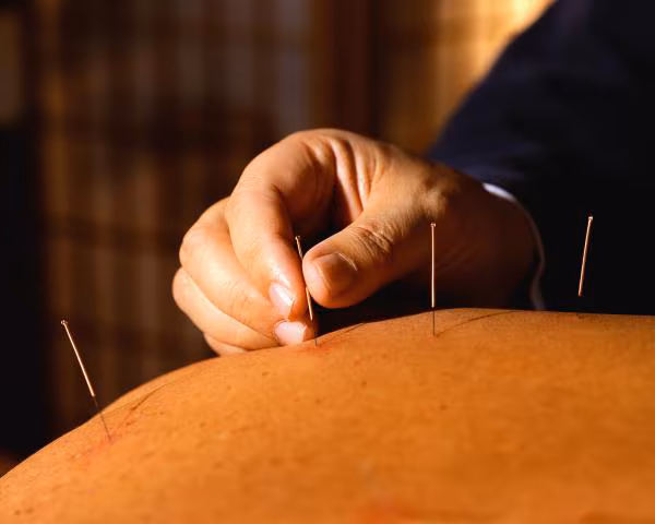 Acupuntura para la infertilidad