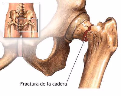 Medicina natural para las fracturas y traumatismos