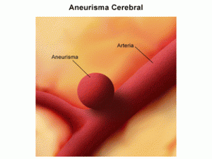 Síntomas de aneurisma