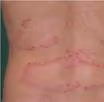 Remedios de homeopatía para la psoriasis