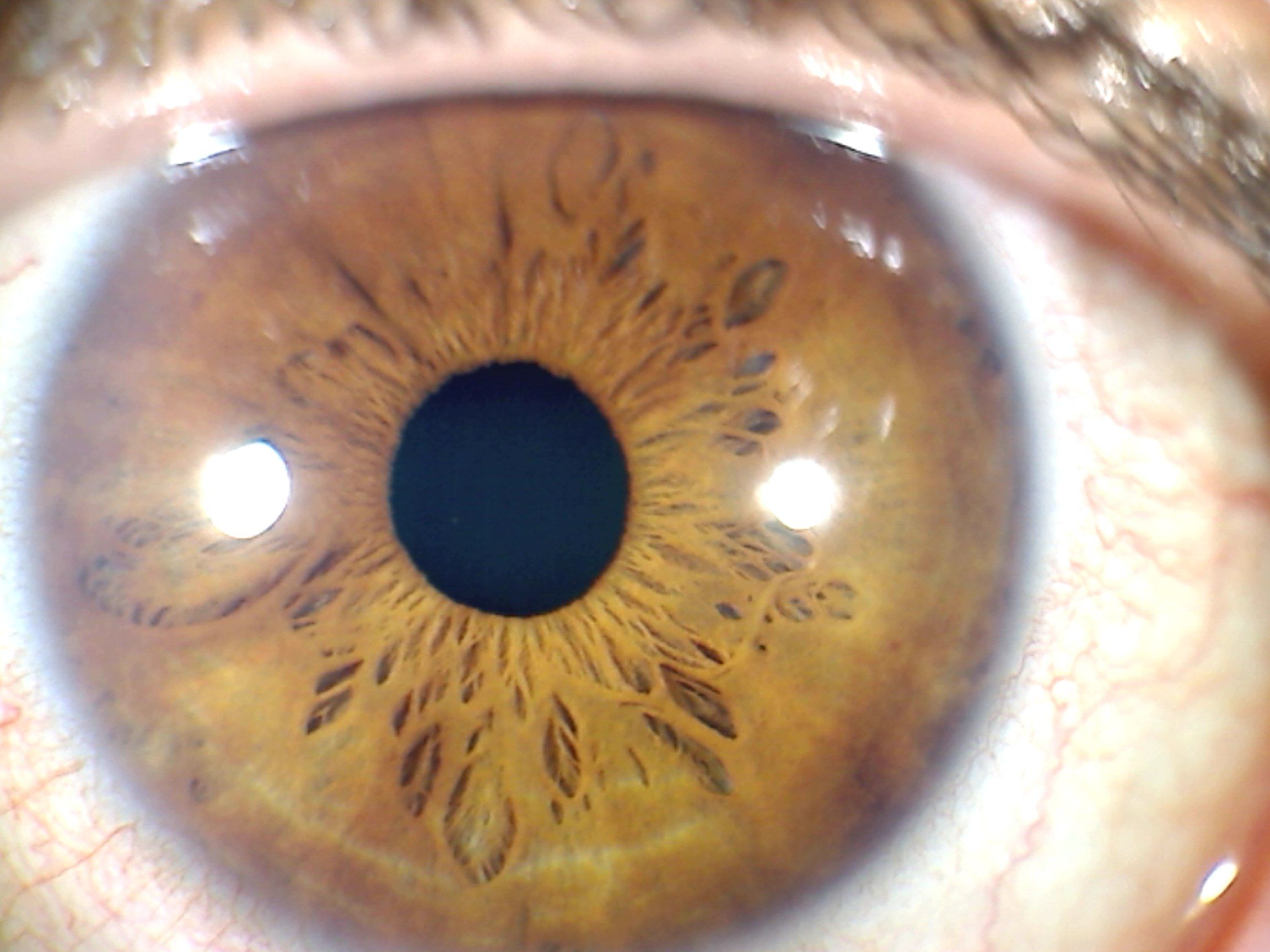 Дисперсия глаза. Синдром пигментной дисперсии. Пигментная дисперсия глаза. Пигментная дисперсия радужной оболочки.