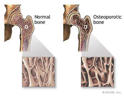 Homeopatico para osteopenia medicamento