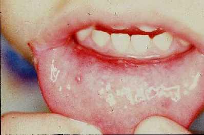 Medicina natural para las enfermedades de la boca