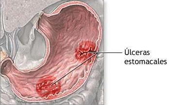 Medicina natural para las úlceras del estómago