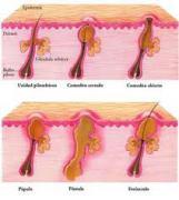 Medicina natural para el acné