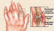 Síntomas de la artritis