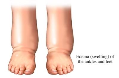 Síntomas de los edemas