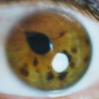 Diagnóstico por la pupila - Iridología