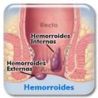Remedios homeopáticos para hemorroides