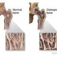 Medicina natural para la osteoporosis