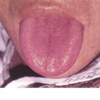 Saburra delgada de la lengua