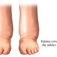 Síntomas de los edemas